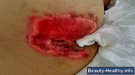 Síntomas de úlcera pilórica: edema, dolor abdominal al sentarse