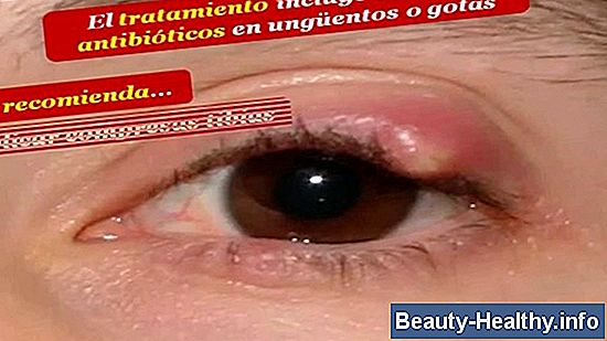 S铆ntomas de una infecci贸n Staph MRSA
