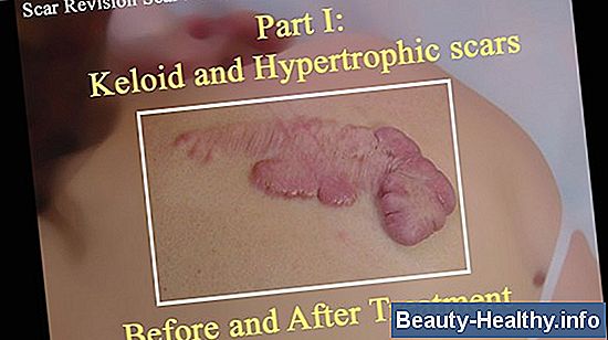Kenalog Injection Vs. Kortisoninjektion
