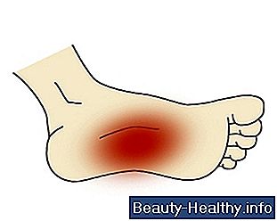 Ejercicio y dolor en el pie arqueado