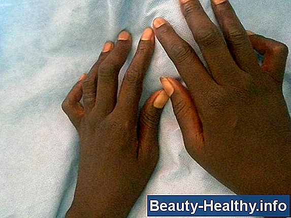 Stecche della mano per l'artrite reumatoide