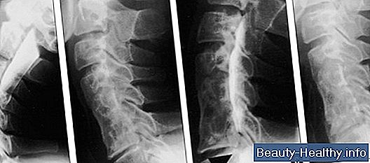 Multilevel Degenerative Disc Disease