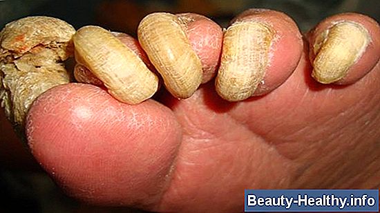 Cures for tykke gule toenails