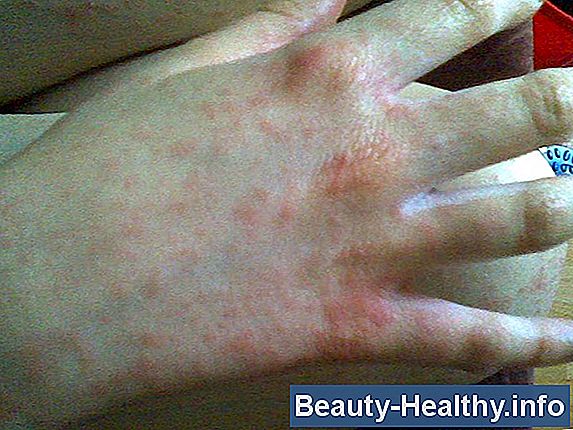 HIV & Mono Symptom