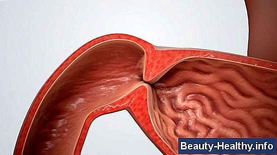 Pyloric Ulcer Symptom: Ödem, buksmärta vid sittande