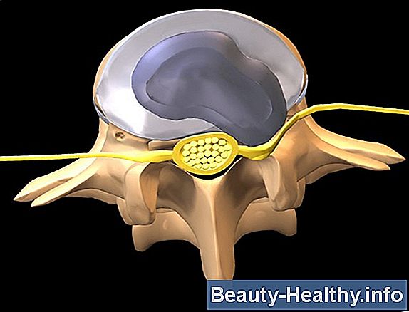 Hva er End Plate Sclerosis?