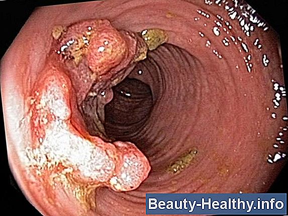 Advanced Colon Cancer Symptom