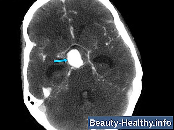 Basilar Artery Aneurysm Symptom