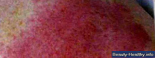 Svullna mjälten Symptom