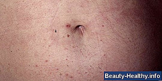 Vad ska scabies se ut?