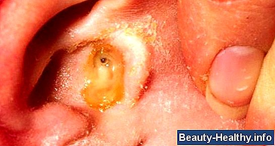 Human Ear Parasites forårsager smerte