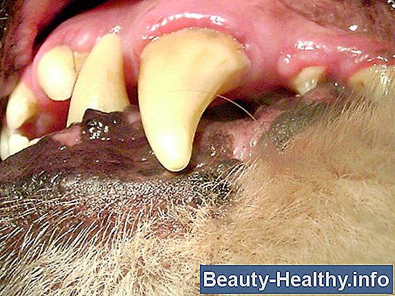 Wie man schweren Zahnstein von den Zähnen bekommt