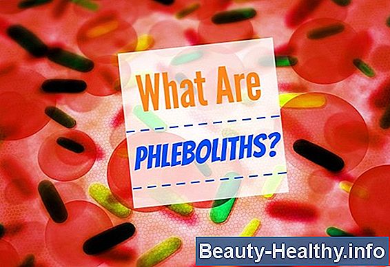 Phlebolith Symptoms