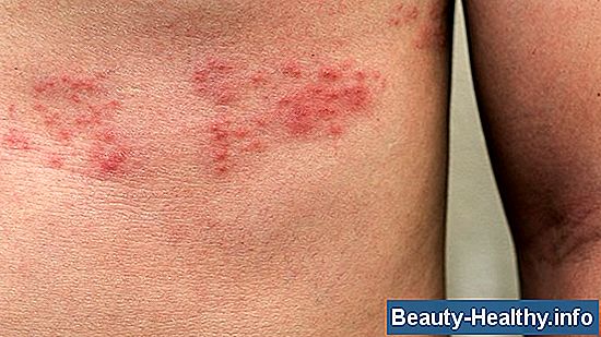 The Stages of Shingles Rash