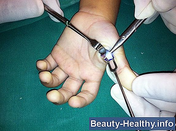Como consertar um dedo de gatilho sem cirurgia