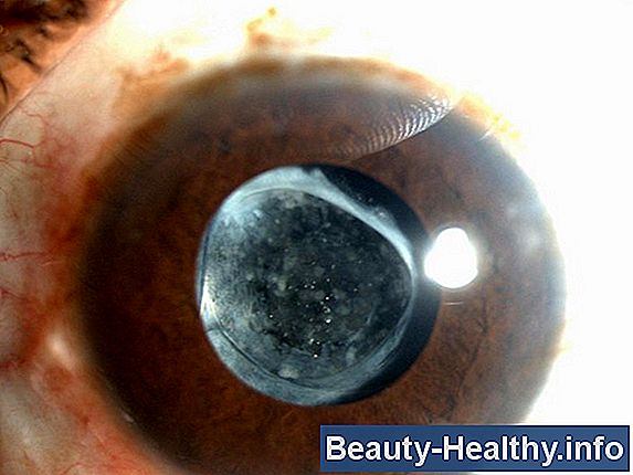 O que é cirurgia de Yag Eye?