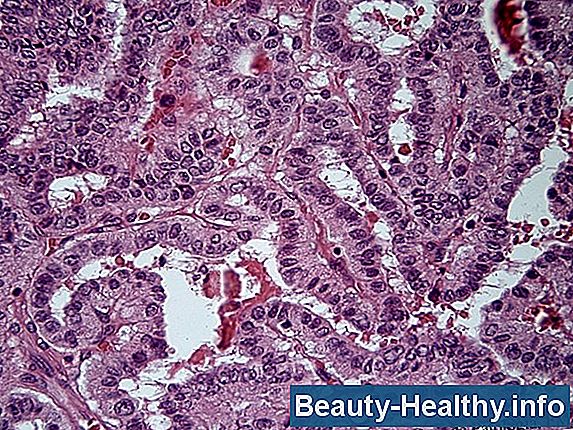 O que é carcinoma urotelial de alto grau?