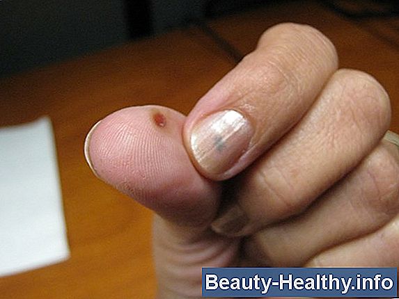 ¿Qué causa quemaduras en las yemas de los dedos?