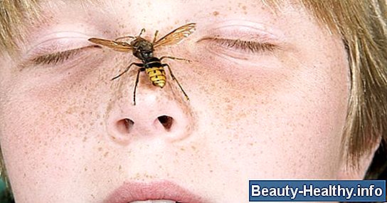 Cómo detener la hinchazón de una picadura de mosquito cerca del ojo