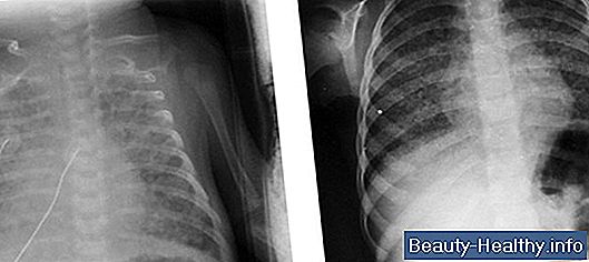 Síntomas de tuberculosis en los huesos