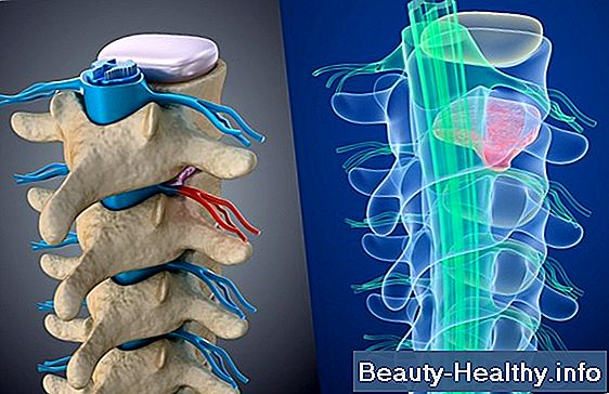 Come alleviare il dolore alla spalla con terapia a punti trigger
