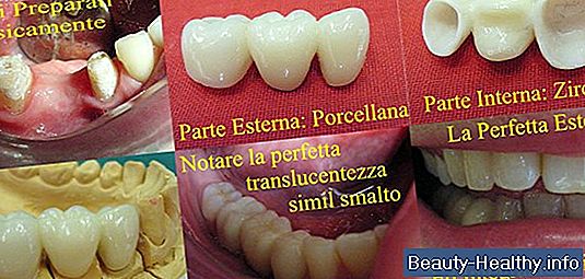 Come cementare una corona dentale senza il dentista