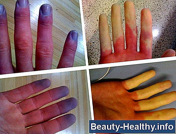 Perché le dita diventano bianche e diventano intorpidite?