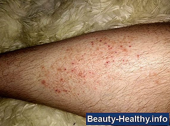Vad orsakar kliande hud på natten?