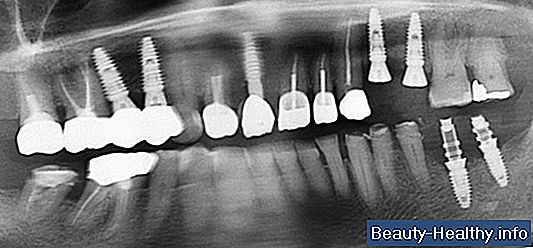 Diş Ekstraksiyonlarından Ne Kadar Sonra Protezlere Hazır mısınız?